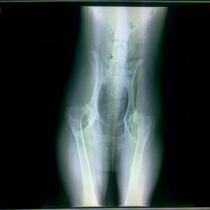 X-ray of Hips showing severe dysplasia