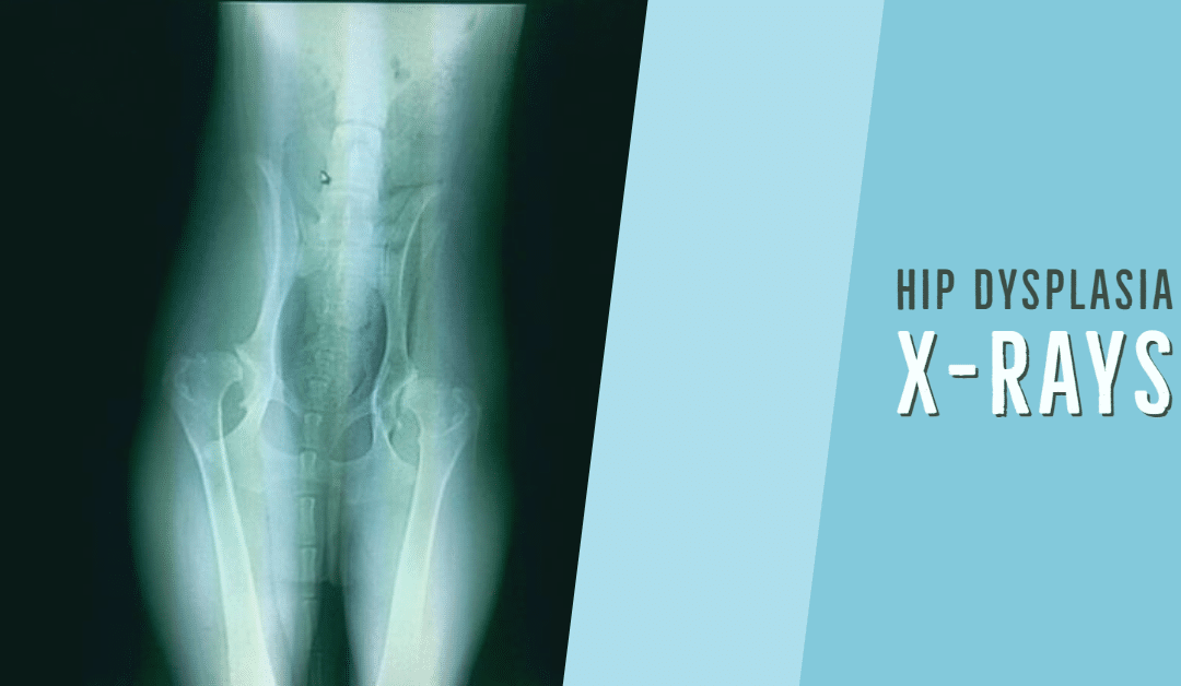 Bacio’s Hip Dysplasia X-rays
